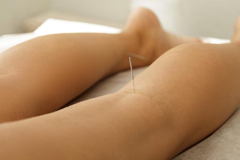 Imagen ilustrativa de un tratamiento con punción seca de fisioterapia a domicilio.